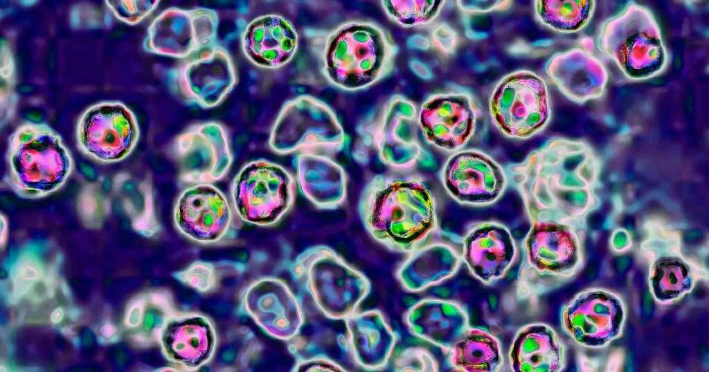 Coroner details two baby deaths in Pennsylvania measles outbreak