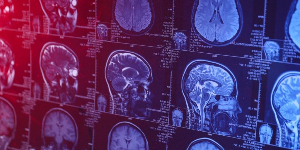 Big neuroscience study on antidepressants and brain structure