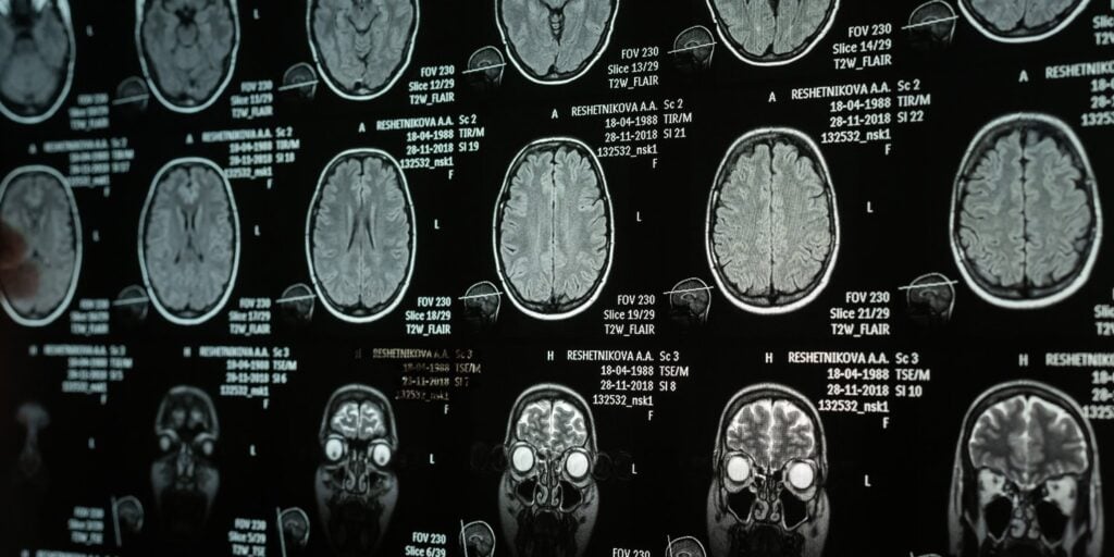 Age-specific brain plasticity in puberty, pregnancy and menopause