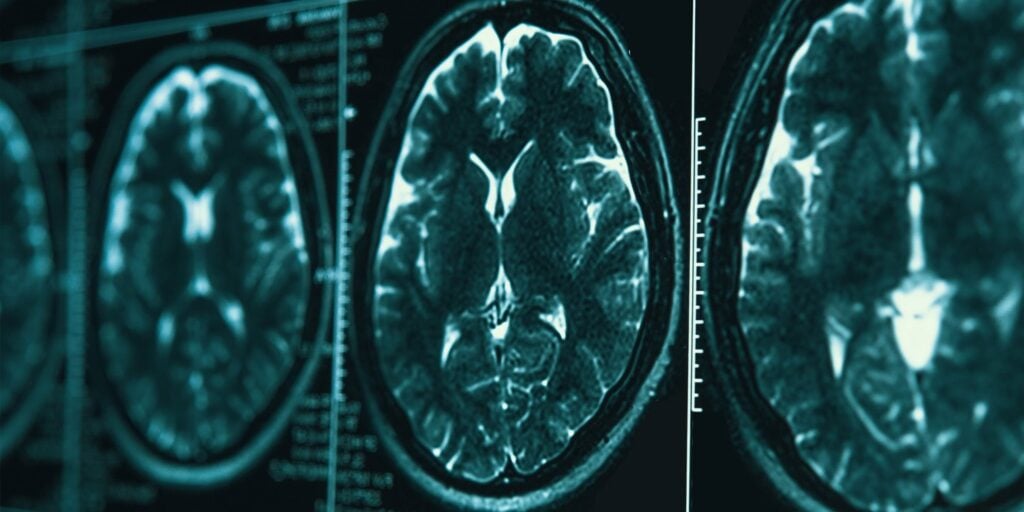 Brain architecture linked to antidepressant response in patients