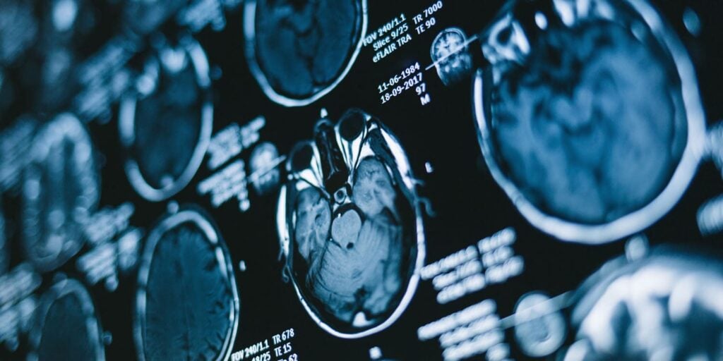 Childhood war exposure linked to attachment anxiety and avoidance