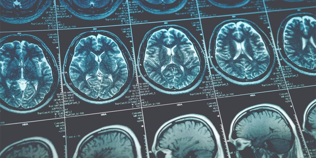 Brain scans show contrasting reward responses in ADHD and autism