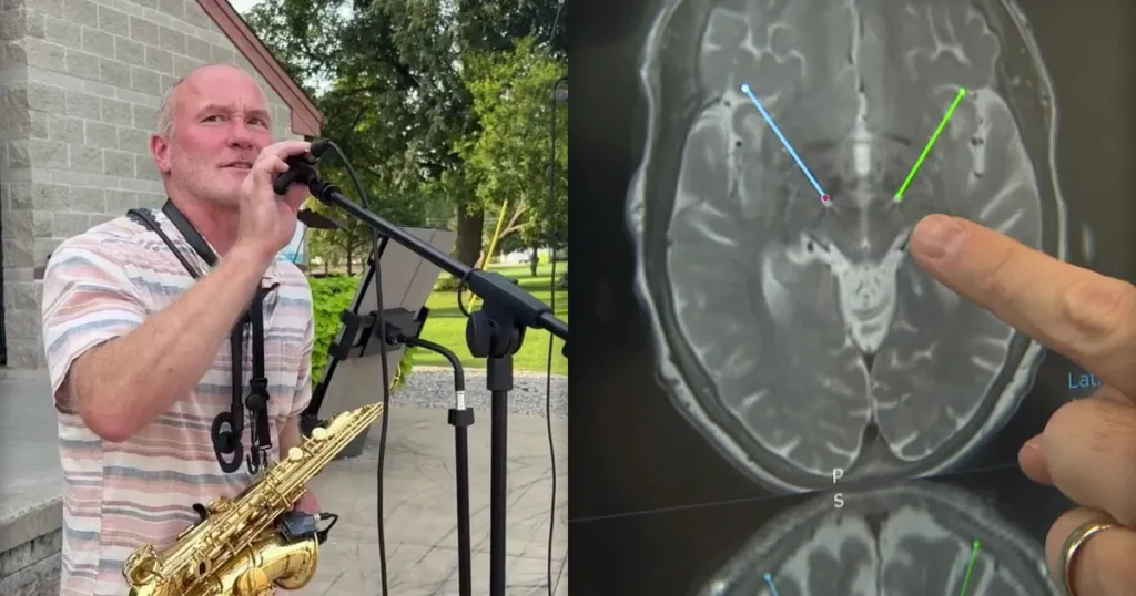 Hartland musician manages Parkinson’s through deep brain stimulation