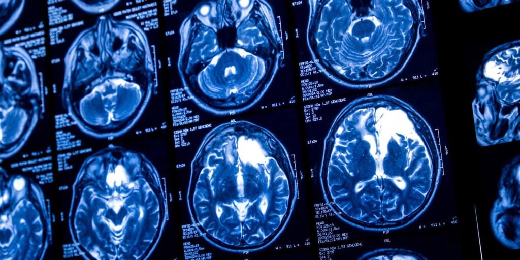 Creativity in drawing linked to brain’s white matter