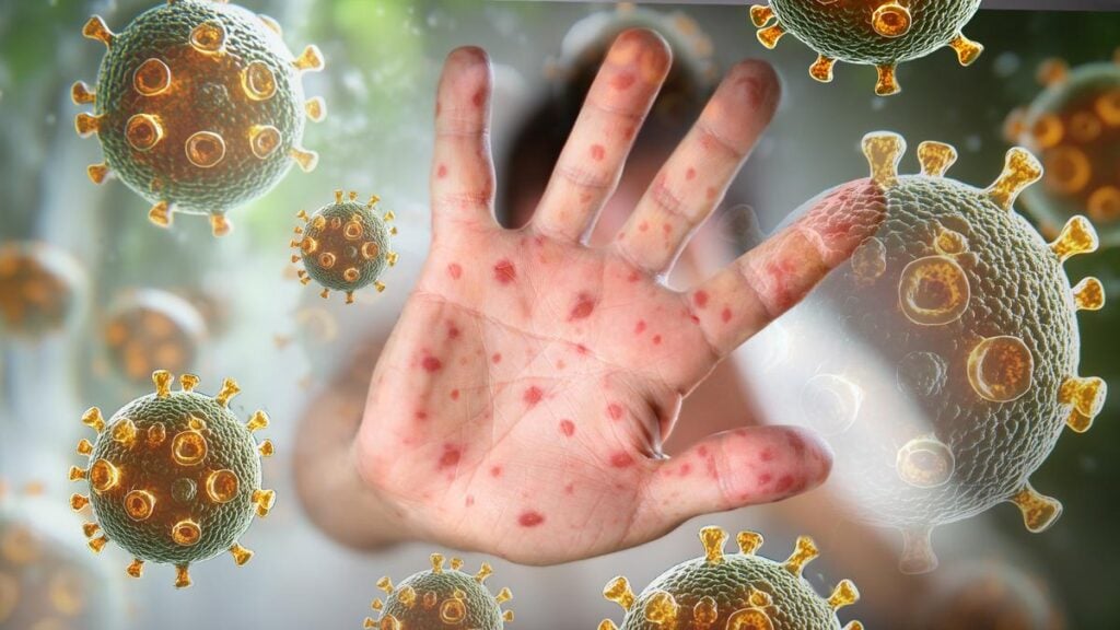 Armadale Hospital measles exposure site after WA child diagnosed